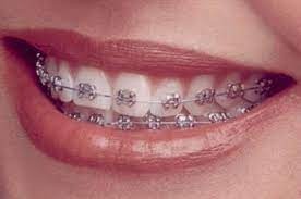 Braces in Dubai